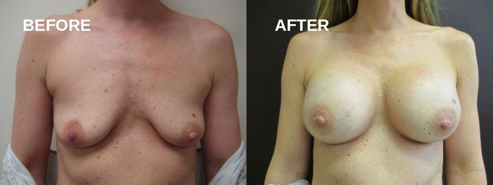 Breast augmentation