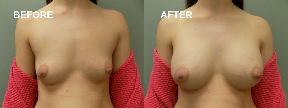 Breast augmentation