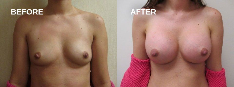 Breast augmentation