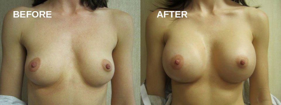 Breast augmentation