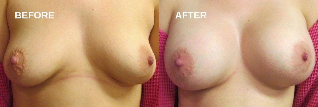 Breast augmentation