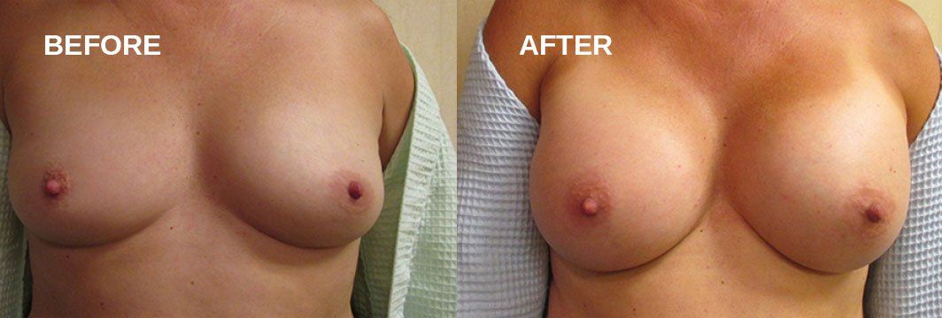 Breast augmentation