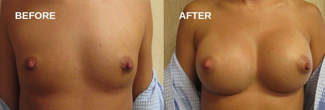 Breast augmentation