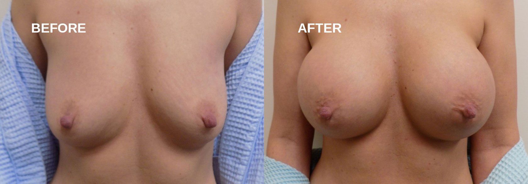 Breast augmentation