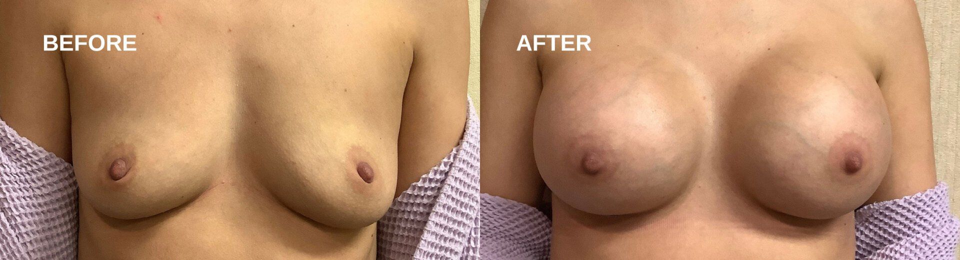 Breast augmentation