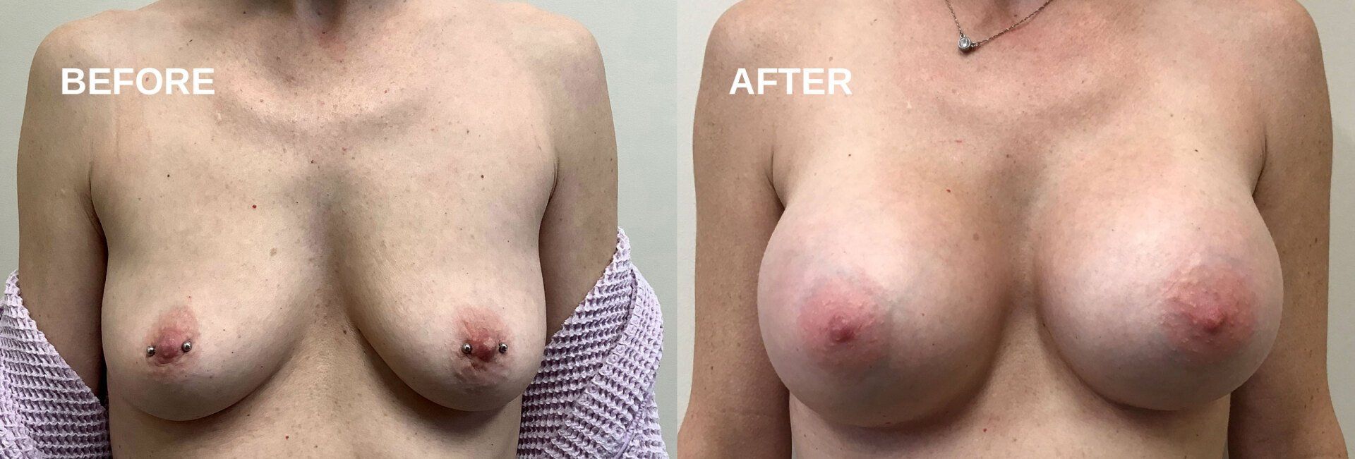 Breast augmentation