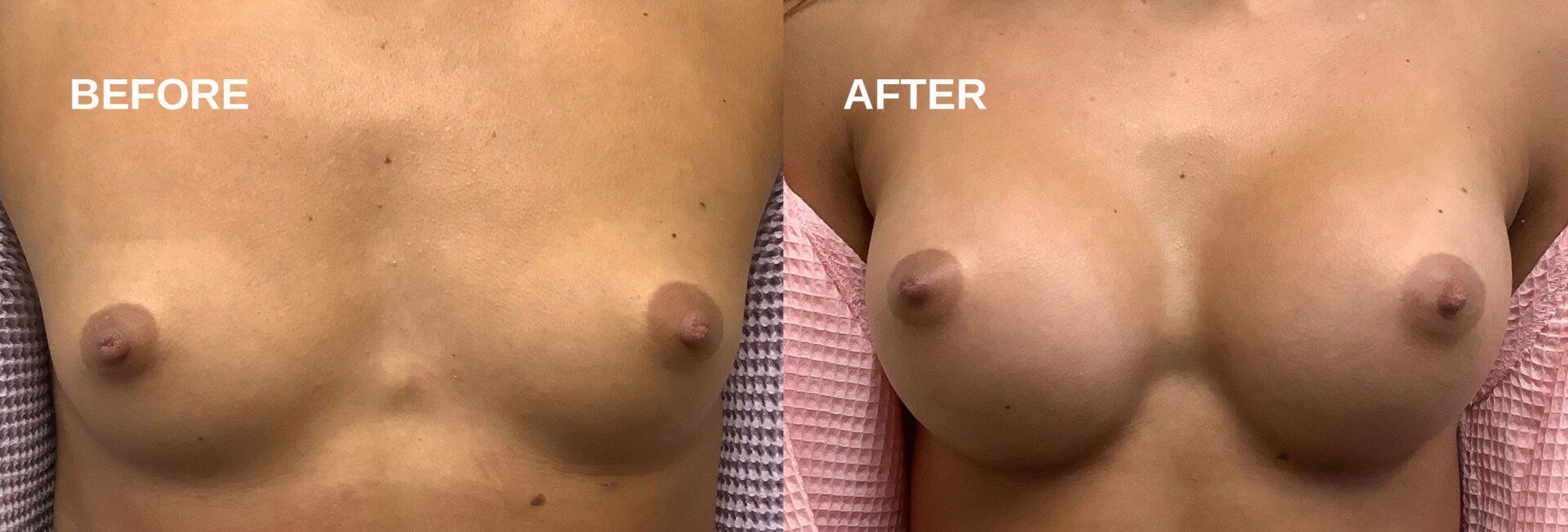 Breast augmentation