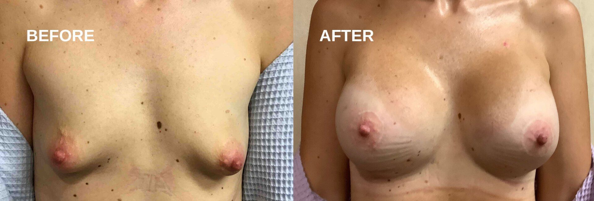 Breast augmentation