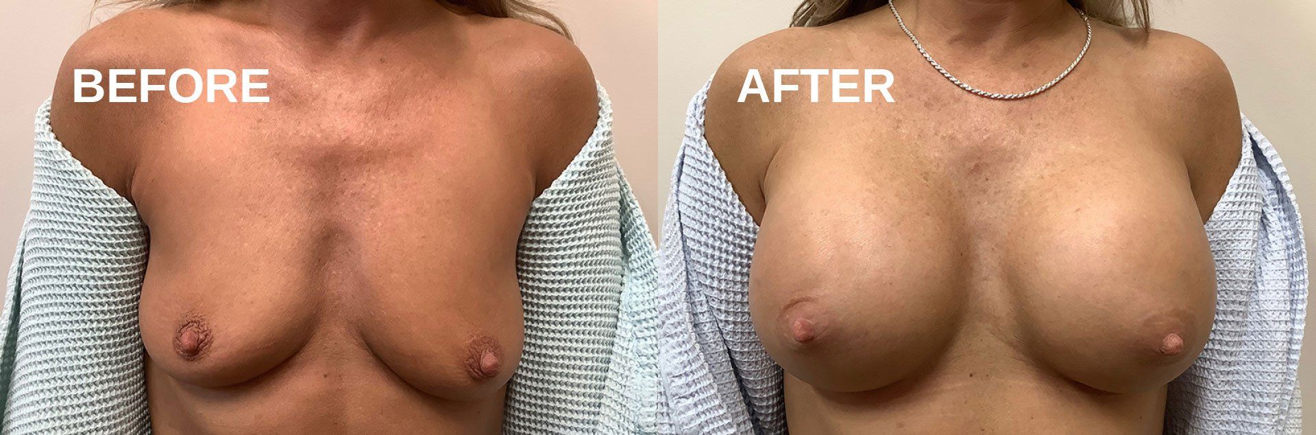 Breast augmentation