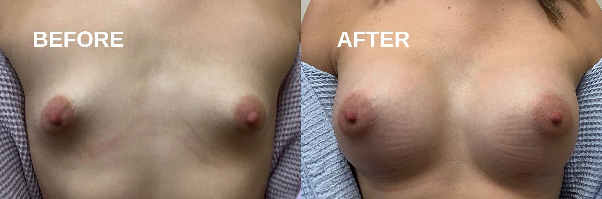 Breast augmentation