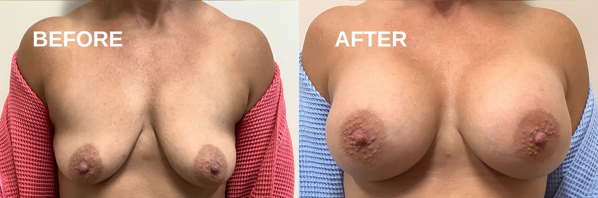 Breast augmentation