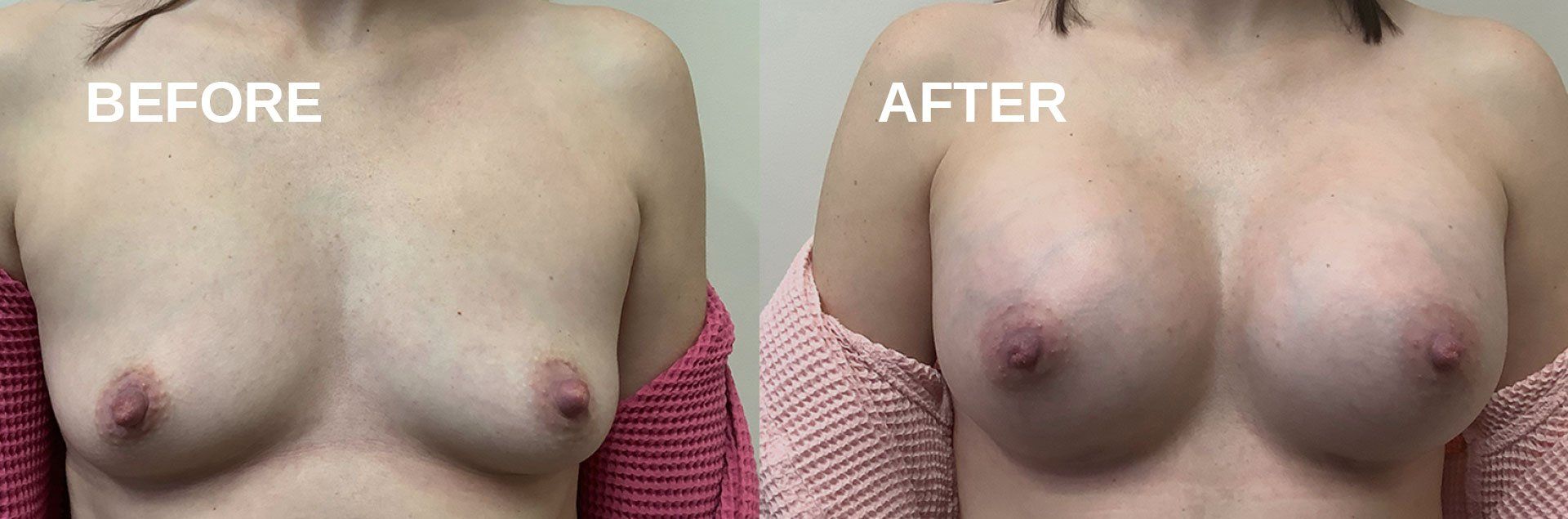 Breast augmentation