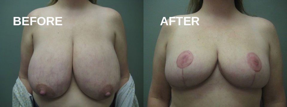 Breast reduction