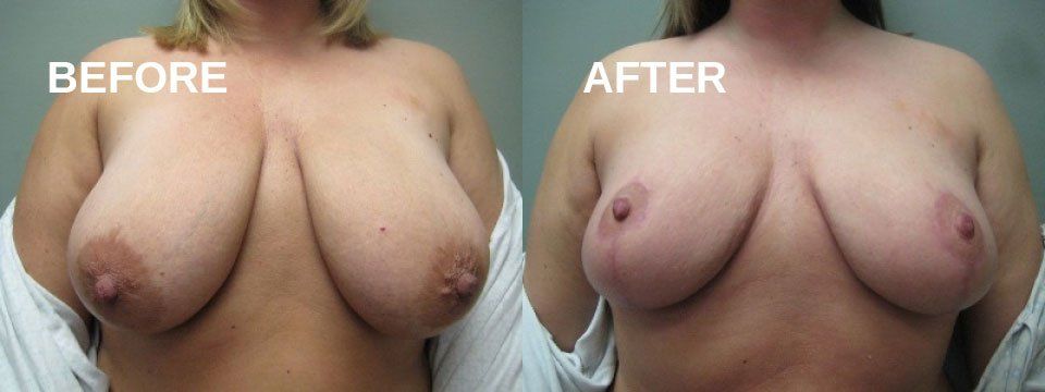 Breast reduction