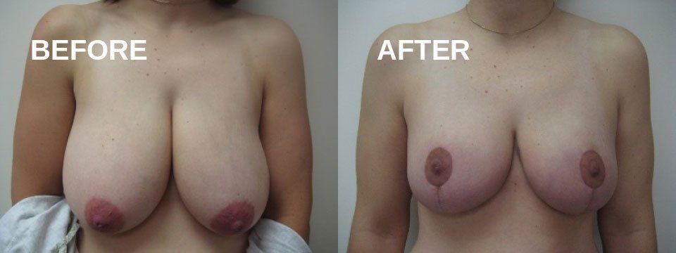 Breast reduction