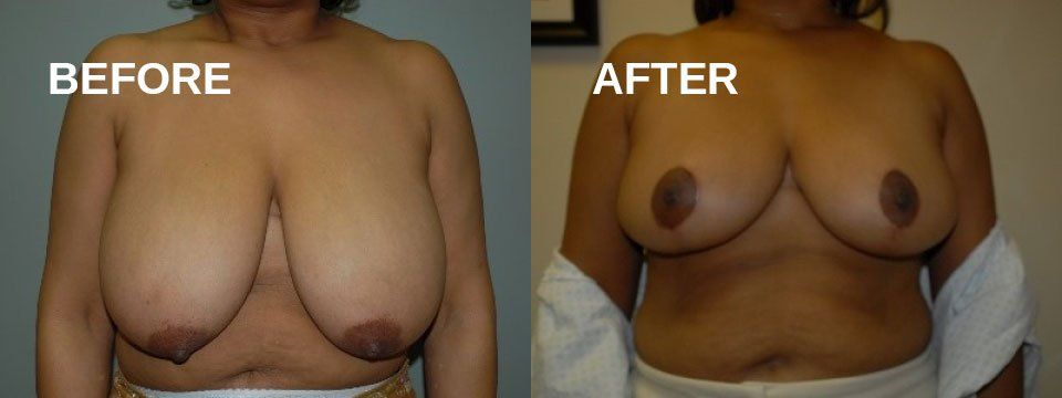 Breast reduction
