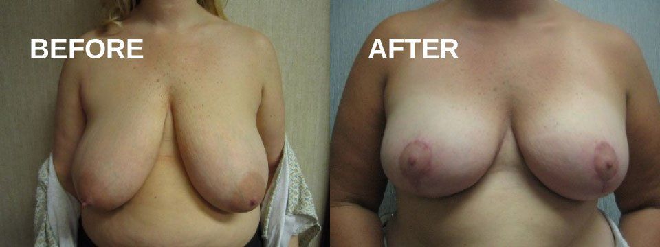 Breast reduction