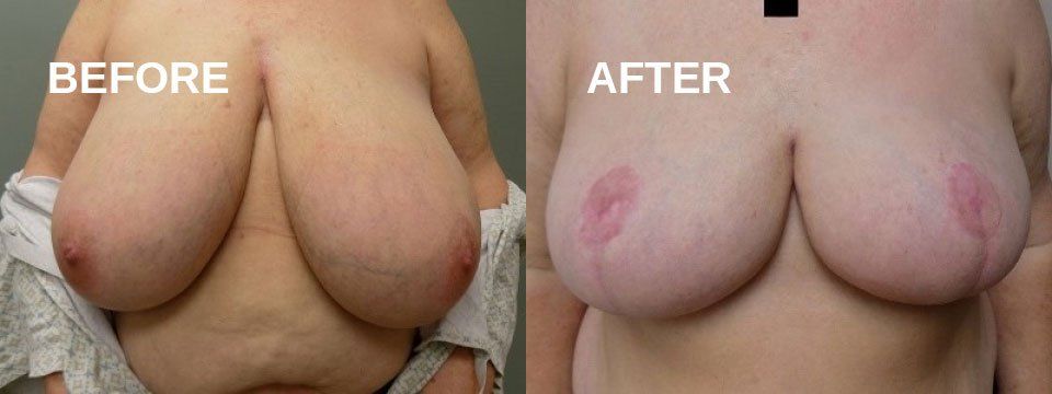 Breast reduction