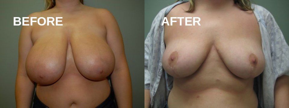 Breast reduction