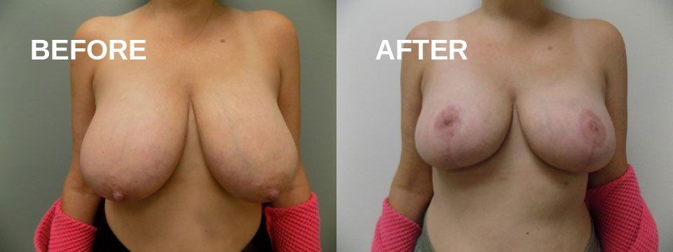 Breast reduction