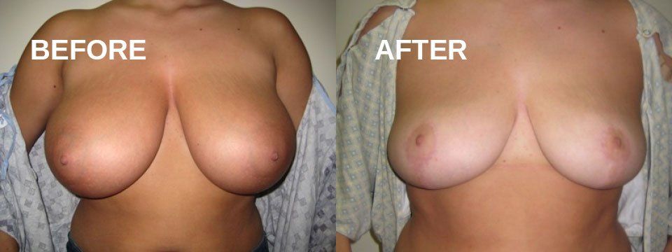 Breast reduction