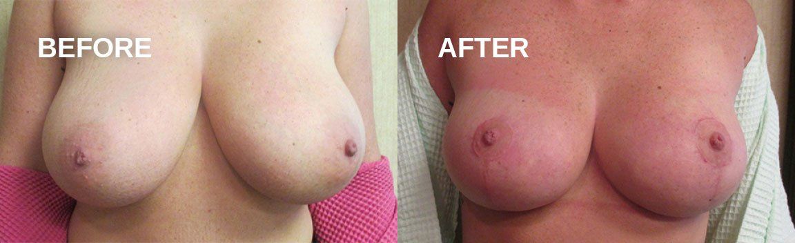 Breast reduction