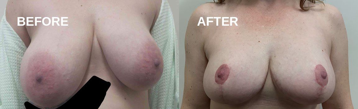 Breast reduction
