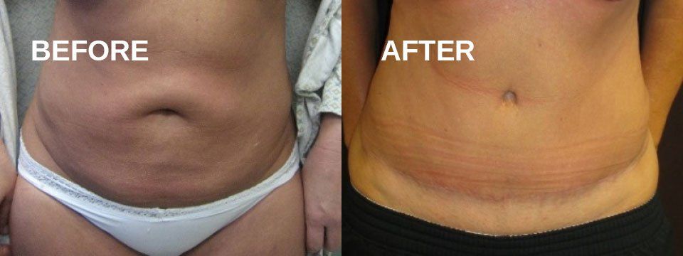 Tummy tuck