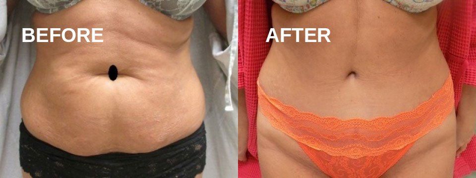 Tummy tuck