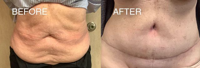 Tummy tuck before and after