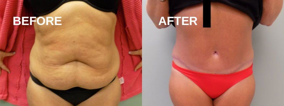 Tummy tuck