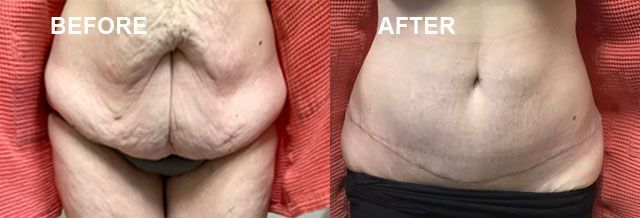 A before and after picture of a woman 's stomach