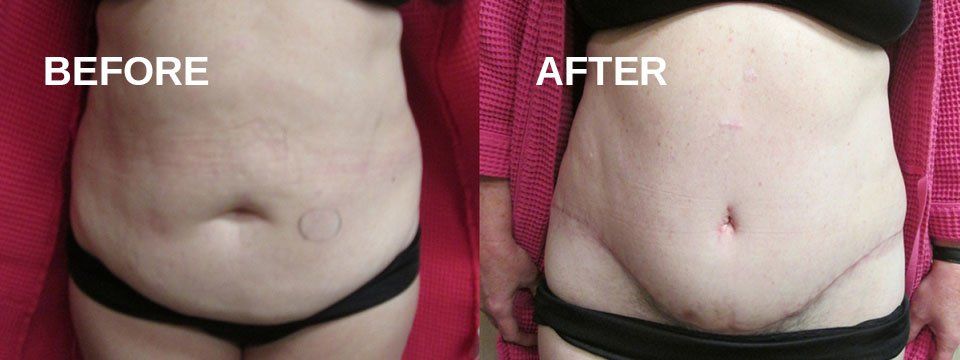 Tummy tuck