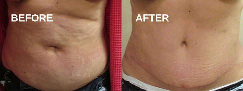 Tummy tuck