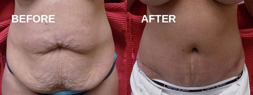 Tummy tuck