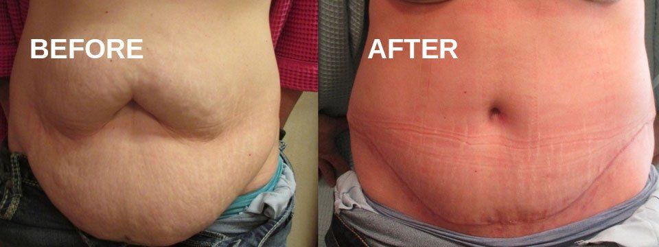 Tummy tuck