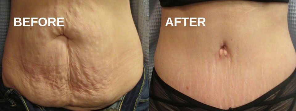 Tummy tuck
