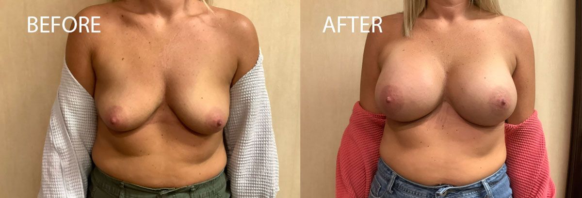Breast augmentation before and after photos. Woman with enlarged breasts after the procedure.