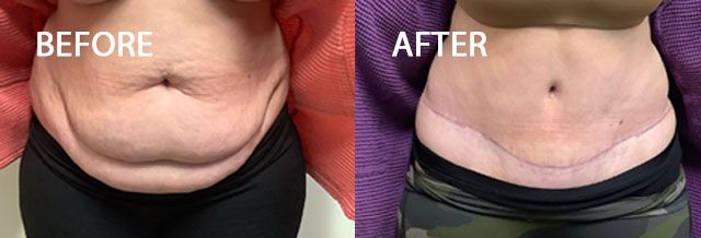 Before and after photo showing a woman's abdomen. The