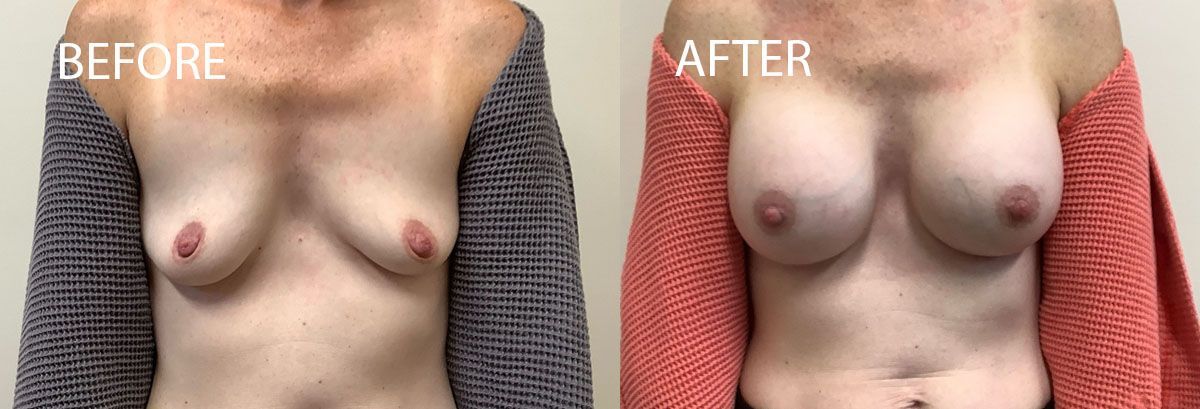 Side-by-side comparison: breasts before and after a procedure. The after breasts appear fuller and rounder.