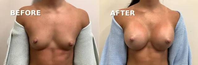 before and after breast augmentation