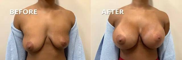 Breast augmentation before and after