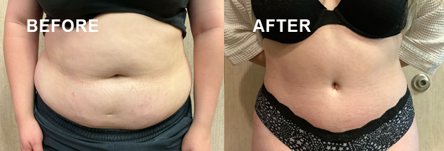 A before and after picture of a woman's stomach.