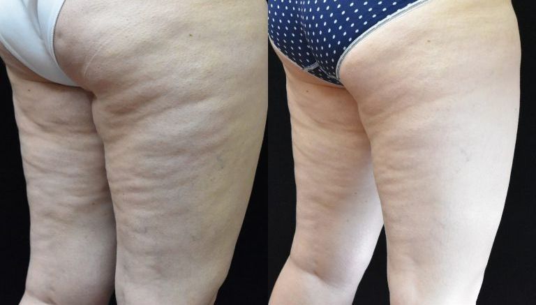 Close-up of two people’s lower bodies in swimsuits, showing visible cellulite on their thighs and buttocks.