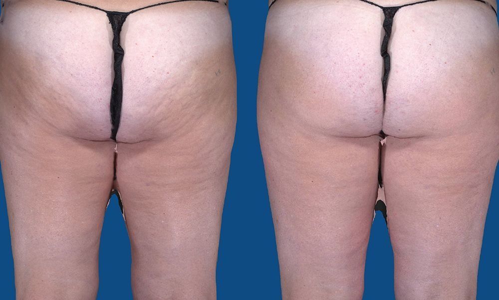 Side-by-side close-up of buttocks in underwear, showing skin texture and dimpling before and after treatment.