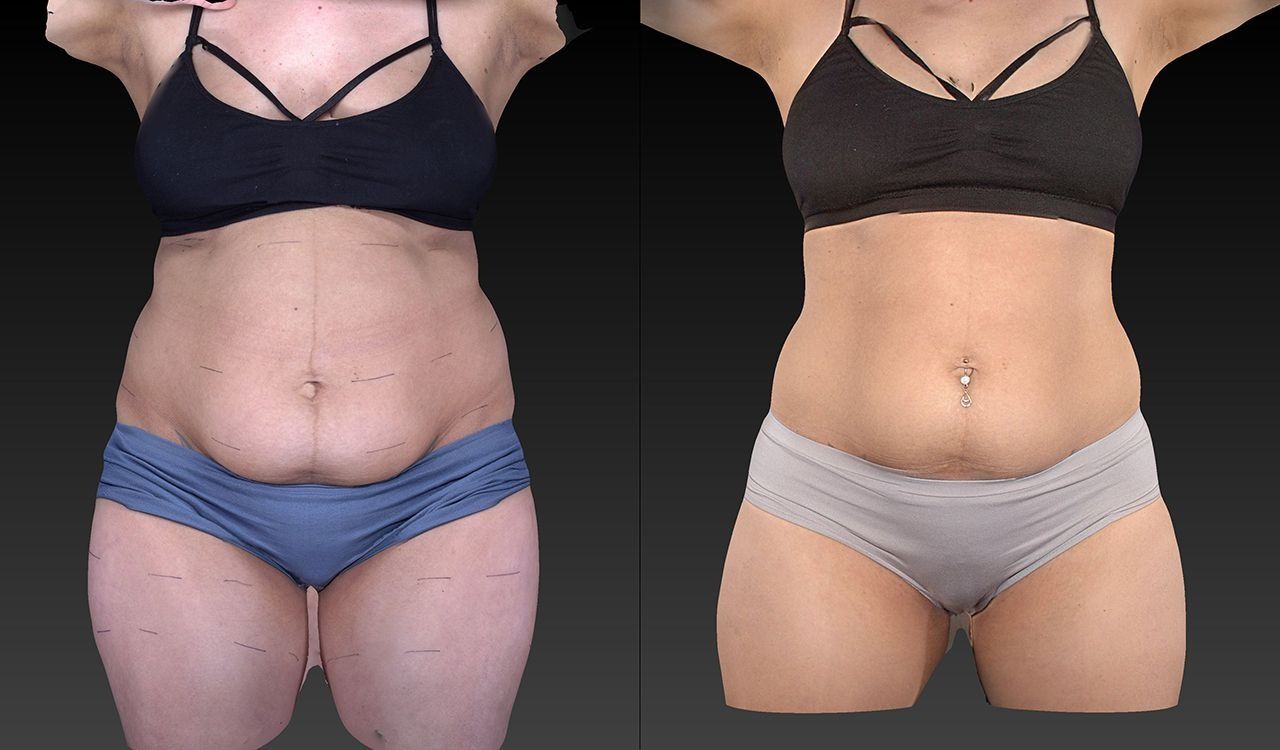 Side-by-side torso comparison of a person before and after weight loss, wearing black top and shorts.