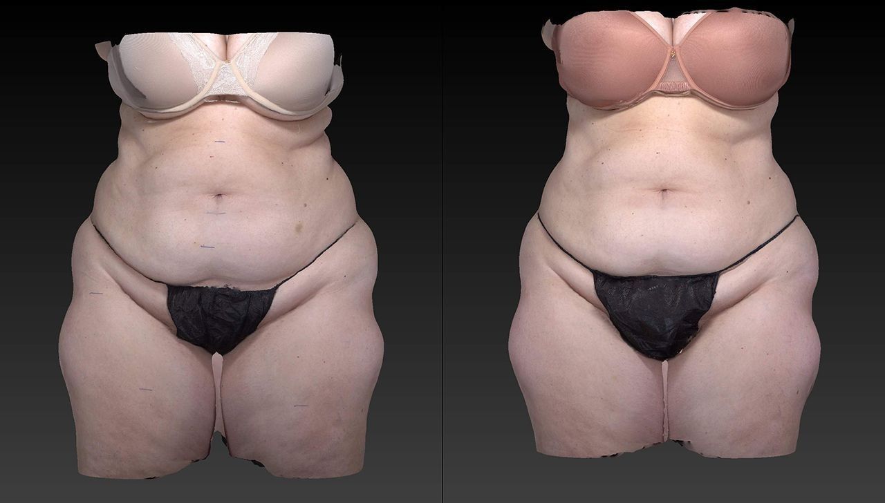 Side-by-side torso photos of a person in black underwear, before and after body shaping treatment.