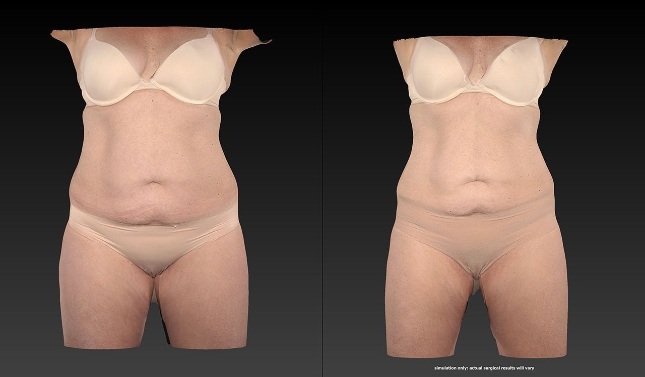 Side-by-side comparison of a woman’s torso in nude underwear, showing before-and-after body shaping.