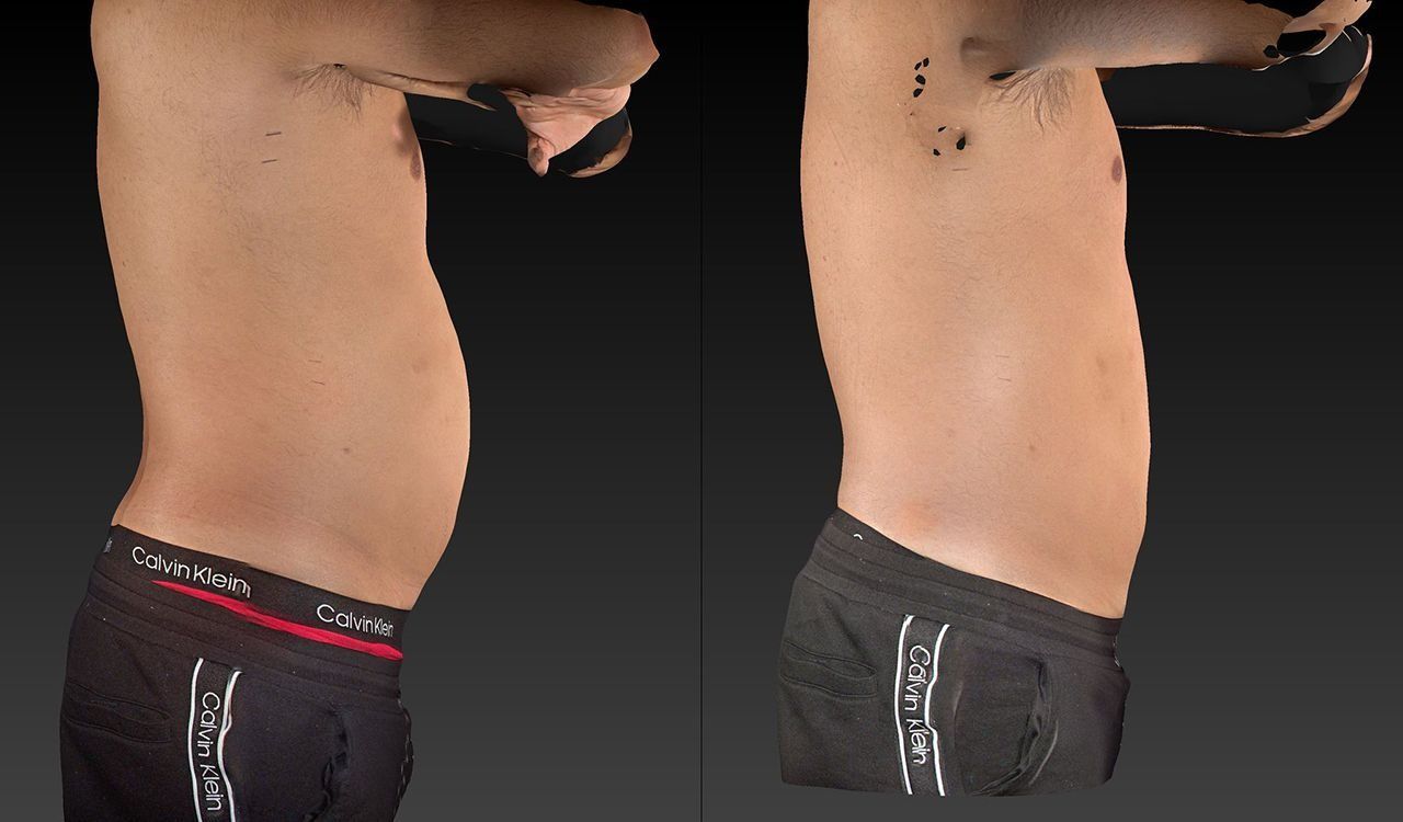 Side-by-side torso photos showing a slimmer midsection compared with a fuller abdomen.