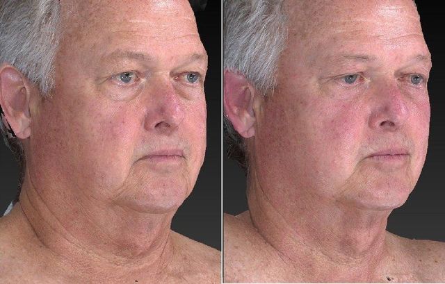 Side-by-side close-up portraits of the same man against a dark background, showing a neutral expression.